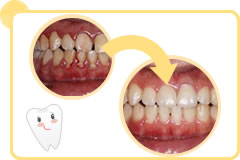 歯周病治療 イメージ